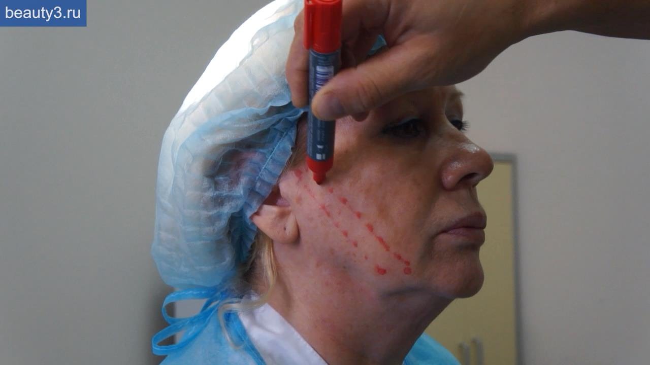 Безоперационная "подтяжка" лица нитями Silhouette Soft