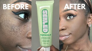 TOPICALS SEALED: THE BEST PRIMER EVER?! INDENTED ACNE SCARS, LARGE PORES