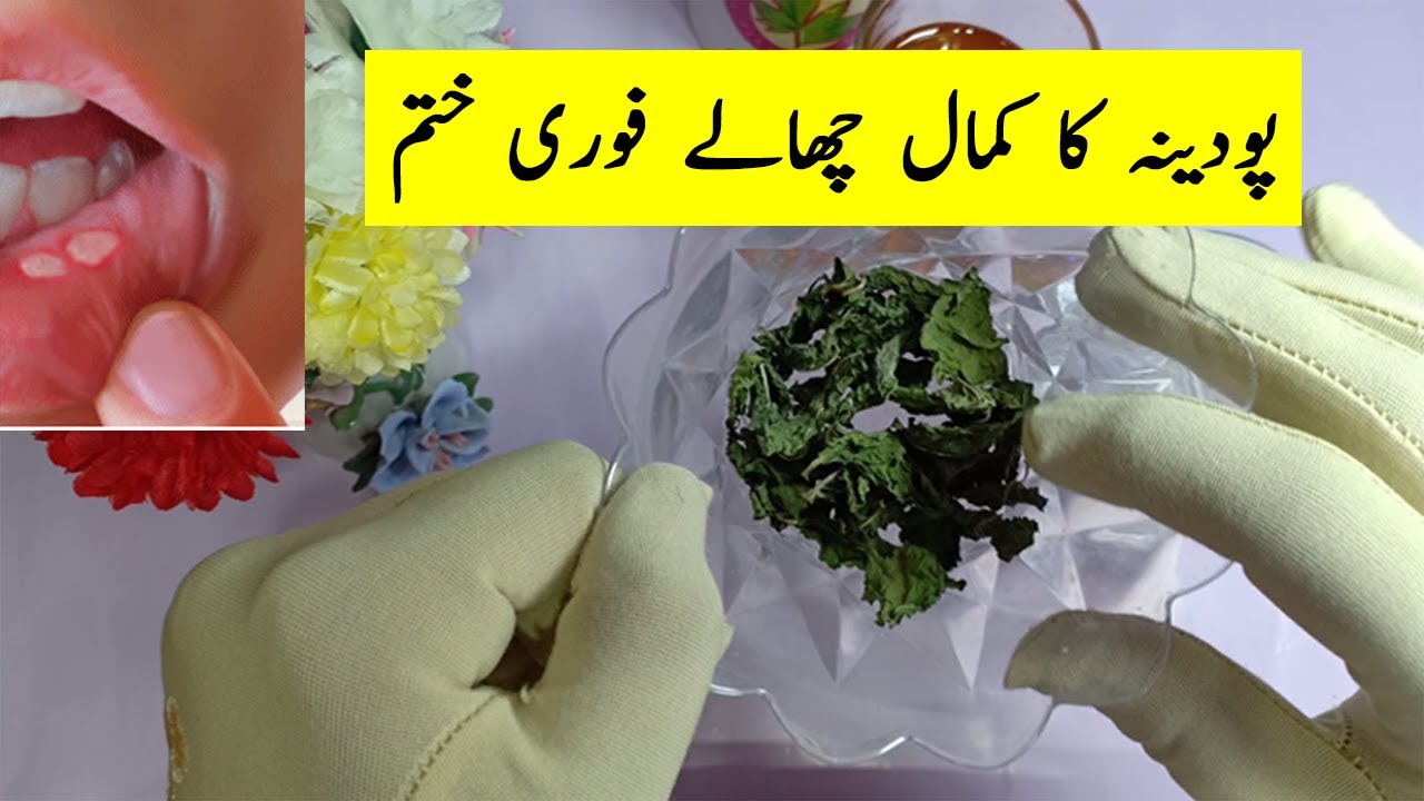 Muh Ke Chalo Ka Ilaj Mouth Blister YouTube