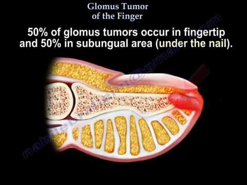 Glomus Tumor Of The Finger - Everything You Need To Know - Dr. Nabil Ebraheim