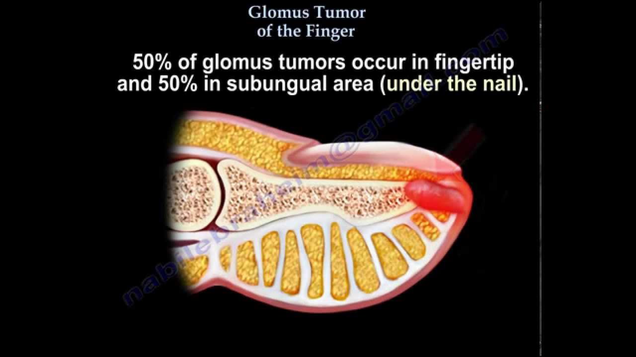 Tumor: Large subungual glomus tumor