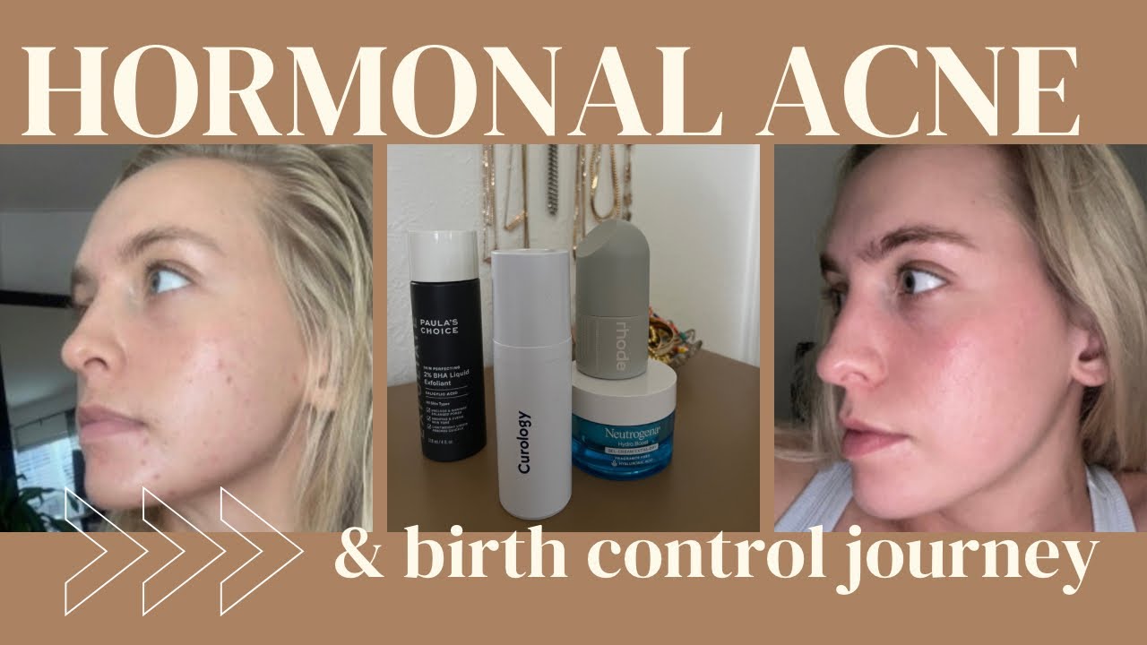 HOW I CLEARED UP MY HORMONAL ACNE AFTER GETTING OFF OF BIRTH CONTROL ...