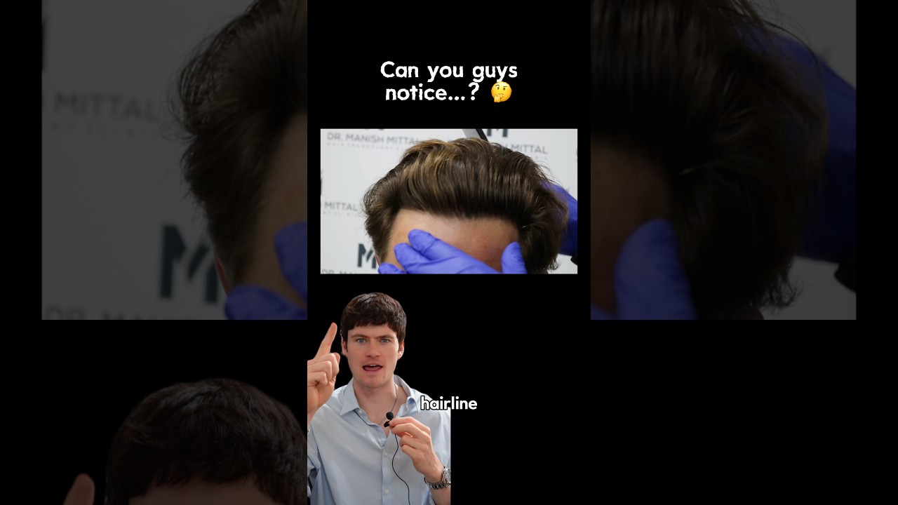 Best hair transplant…?