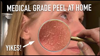 DIY TCA Chemical PEEL 20% | skip2mylou by skip2mylou 6,887 views 11 months ago 13 minutes, 52 seconds