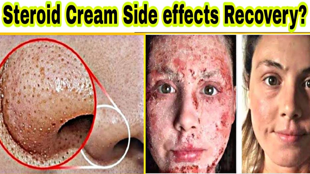 Steroid Creams Side effects & Recovery at Home ? | स्टेरॉयड क्रीम के