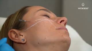 Venome Протокол Стимулюючий Скінбустер Н2О Та Редермалізант Amber Amino Btx, Канюльна Техніка