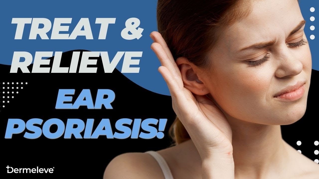 Ear psoriasis natural treatment say goodbye to pain itching youtube