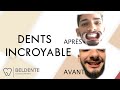 DENTS AVANT/APRÈS, INCROYABLE