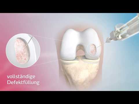 ChondroFiller liquid für die biologische Knorpelregeneration. - video from Meidrix