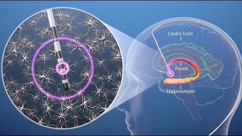 ADvance II Study for Mild Alzheimer