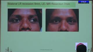 AIOC 2026   IC80   T Dr Rishikesh Mayee Intermittent Exotropia  Recess resect and Bilateral Recessio