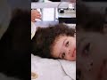 Conjoined twins successfully separated in St. Louis