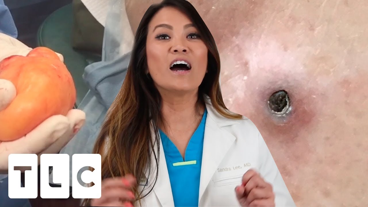 Lav vej administration Revision The Contents Of This Huge Bump Surprises Dr Lee | Dr. Pimple Popper -  YouTube