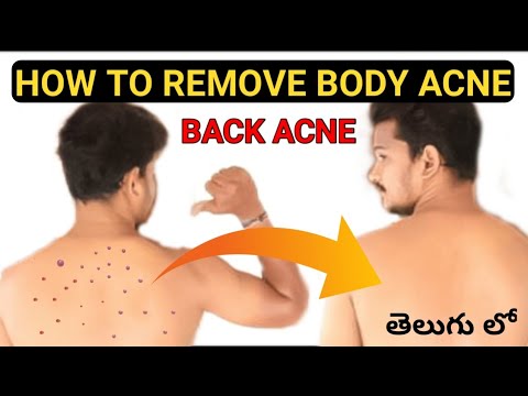 How To Remove Back Acne , Body Acne Marks For Men And Women | Telugu | విపి మొటిమలను ఎలా తొలగించాలి