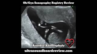 Acardia And Anencephaly