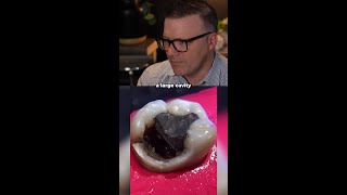 Youre Not Going To Believe This Tooth Is Savable.