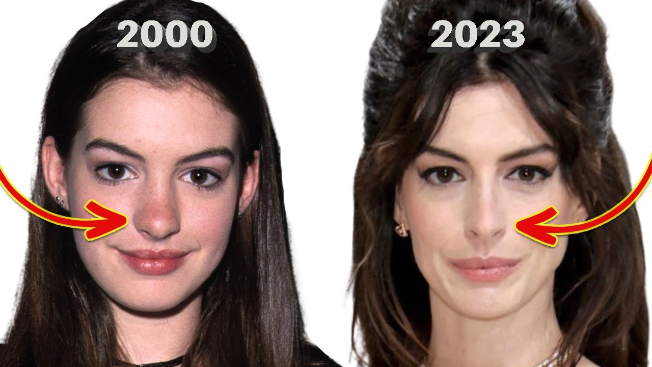 Anne Hathaway's Before and After: Denies Nose Job (Lorry Hill