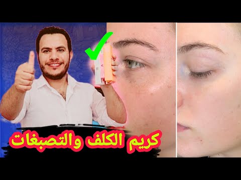 بعد تجربة 18 مليون أفضل كريم لازالة النمش و الكلف والتصبغات وتبييض البشرة يوسف الصقر علاج النمش