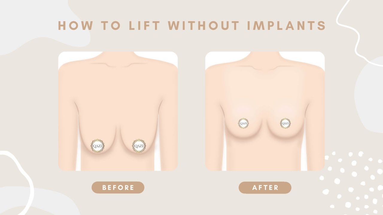 Options for Breast Lift - Everything You Need to Know
