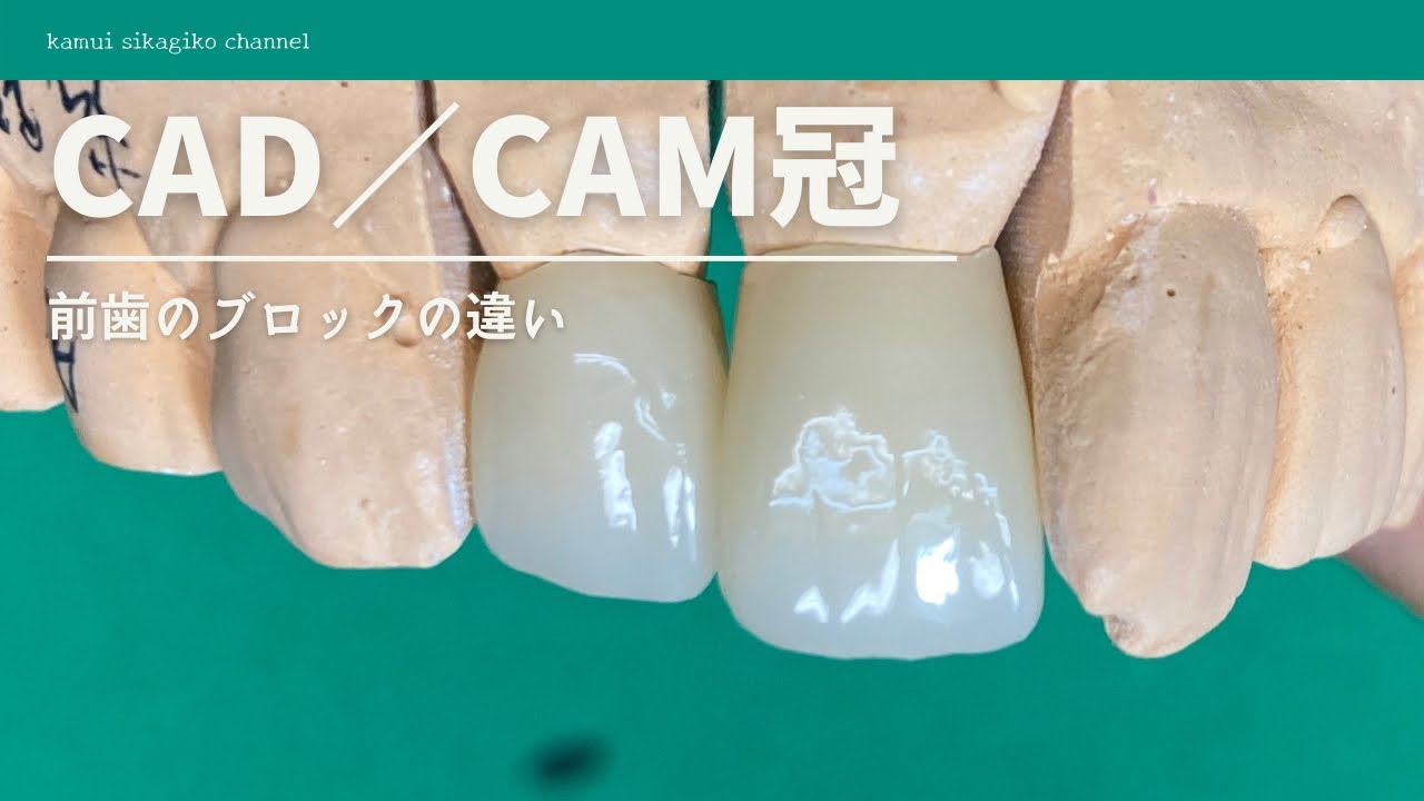 【歯科技工】前歯CADCAM冠ブロックのメーカーによる個体差を知っておく【exocad3.0ソフト】