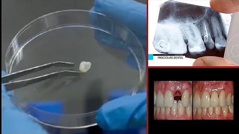 ¿Puede el dentista hacer crecer dientes nuevos?