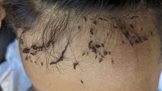 How to remove all hundred head lice at home - Head lice removal at home