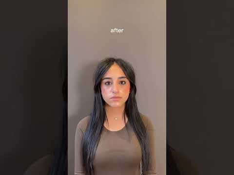 Video thumbnail: Scarless Rhinoplasty Results | Before & After Reveal #rhinoplasty