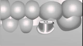 ANKYLOS : Animation Titanium Base