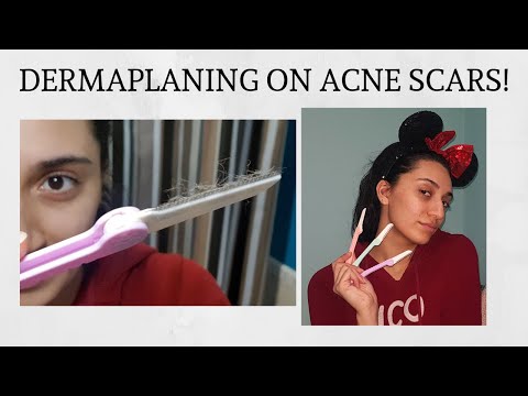 DERMAPLANING ACNE SCARS | DEMO + HONEST REVIEW!
