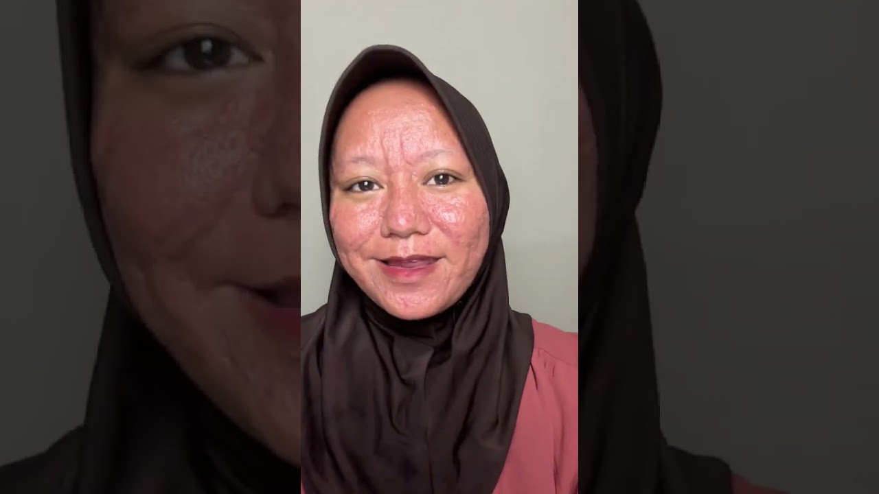 Acnie Spark for Clear, Glowing Skin! 🌟 |  Acne Solution 2025,