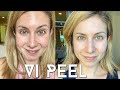 Vi PEEL done at Home | Step by Step Process + Before and Afters