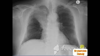 ? Respiratory system ? pulmonary collapse and fibrosis ?