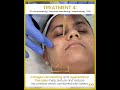 Stubborn pigmentation | Pico technology | Collagen therapies #everythingskinhair