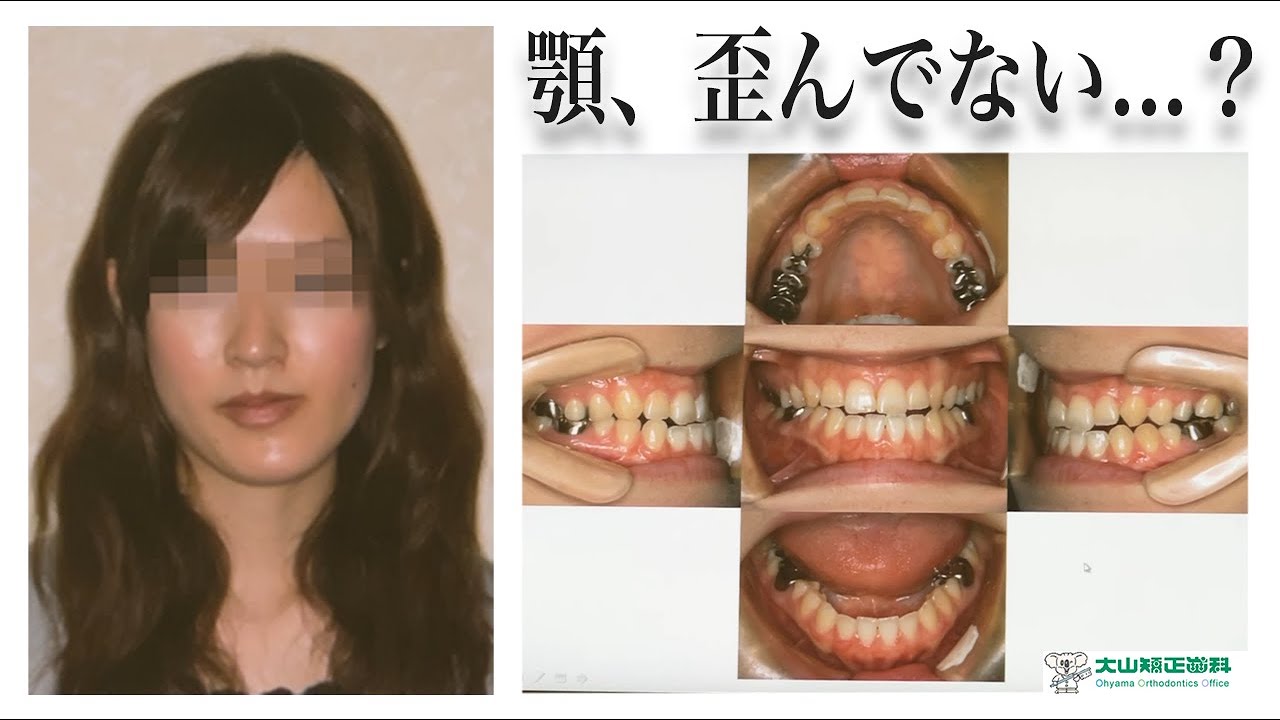 顎変形症】顎が斜めに歪んでいる方へ【名古屋栄の日本矯正歯科学会認定