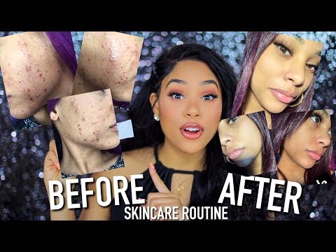 THE SKINCARE ROUTINE / PRODUCTS THAT CURED MY ACNE FOR GOOD!