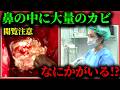 【巨大なカビ】鼻にカビができるタイプの副鼻腔炎の手術を解説します【真菌性副鼻腔炎】