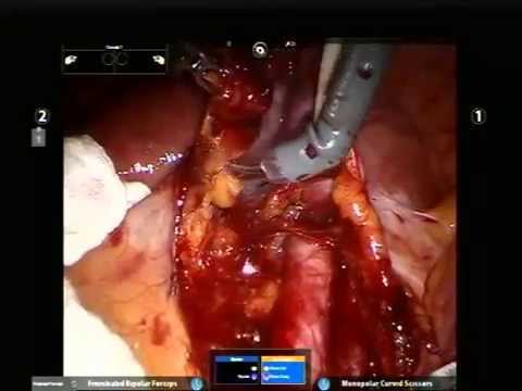 Uterus Cancer IVC Lymph Nodes Staging. - YouTube