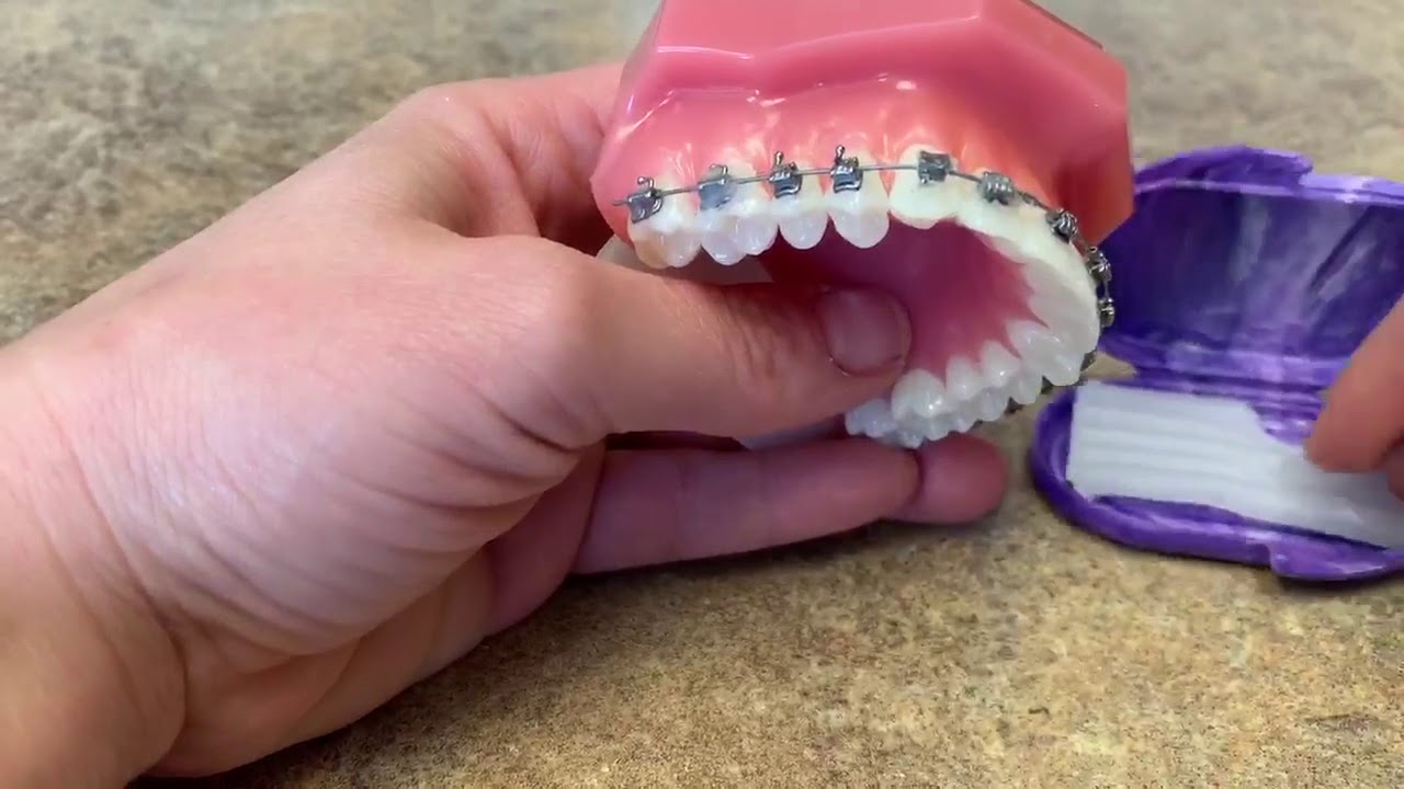 How we Remove a Bracket! | Orthodontist in Broomfield, CO | Braces and Invisalign
