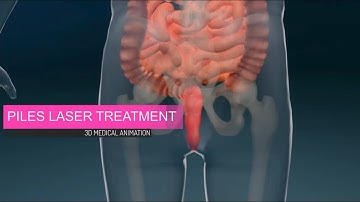 Piles Laser Treatment Explained | Modern, Painless Relief | Piles Best Treatment