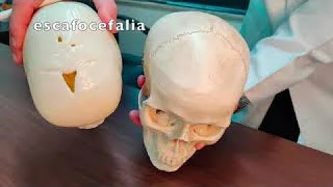 O que acontece quando a moleira fecha antes do tempo?