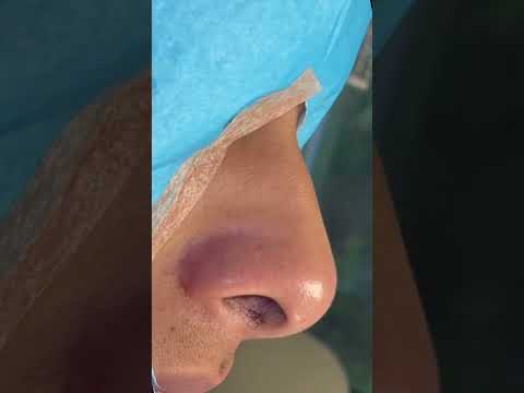 TIP PLASTY ON MEXICAN MALE WITH HUMP ON NOSE