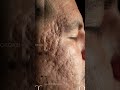 Severe Acne Scar Transformation SkinRestoration