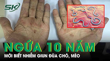 Người Đàn Ông Ngứa Dữ Dội 10 Năm Mới Biết Nhiễm Giun Đũa Chó Mèo |SKĐS
