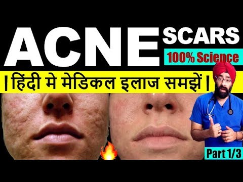 ACNE SCAR SCIENCE & TREATMENT | हिंदी मे मेडिकल इलाज समझे | Explained by Dr.Education | Part /