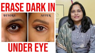 Say GOODBYE To Dark Circles And Under Eye Darkness | Easy Home Remedies For Dark Circles |