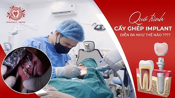 Cận Cảnh Quá Trình Cấy Implant Răng Hàm Dưới Có Ghép Xương| Nha khoa Đặng Xá - S-Dental