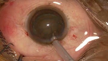Soft Cataract Made Easy!!!!!