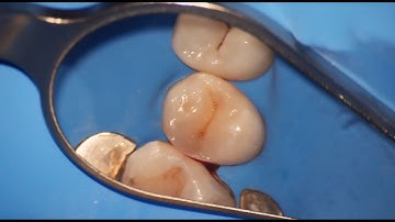 Class Two Composite Restoration Upper Second Premolar