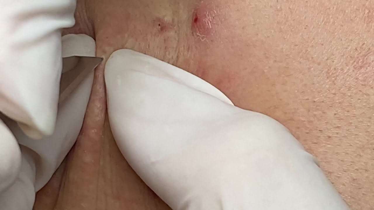 Pimple on neck | Mụn Trên Cổ - SacDepSpa#175