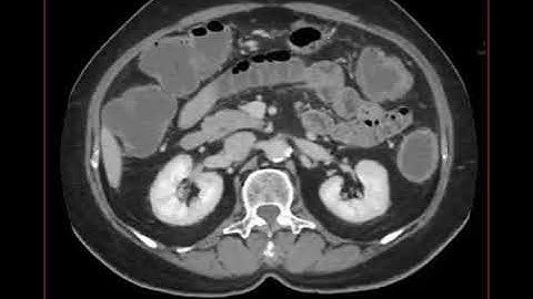 Lâm sàng bệnh nhân nữ 69 tuổi, đau bụng, ngoại tiêu hóa nghi tắc ruột cho chụp CT để đánh giá